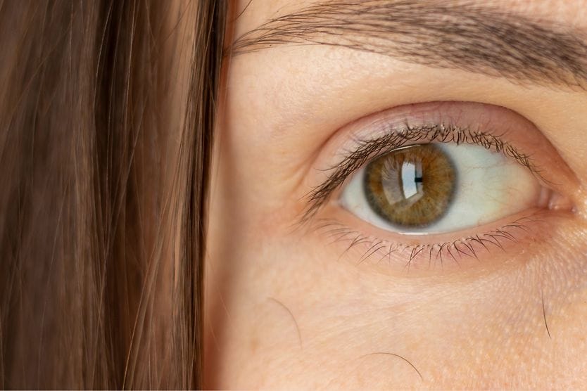 Madarosis: What is it and why does it happen? woman with madarosis (eyelash and eyebrow loss)