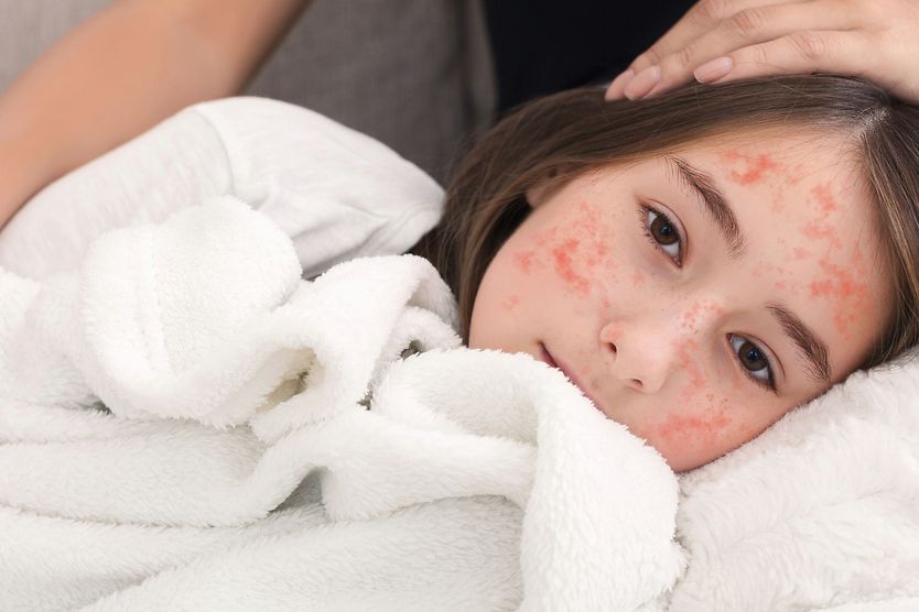 child with measles lying on mother's knees