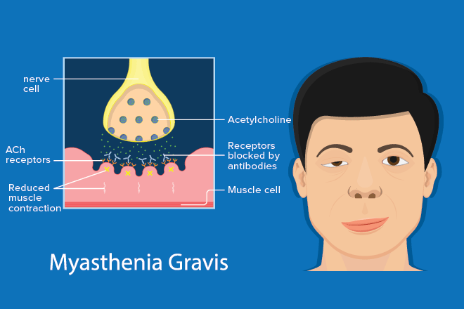 Ocular myasthenia gravis: Symptoms, treatment and pictures