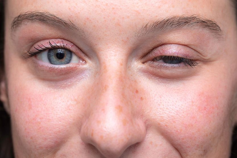 Ocular myasthenia gravis: Symptoms, treatment and pictures woman with ocular myasthenia gravis