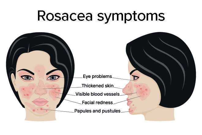 Ocular rosacea Ocular rosacea