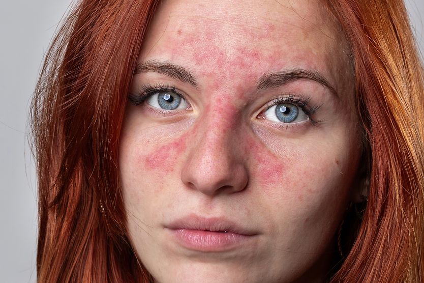 Ocular rosacea closeup of a woman with ocular rosacea