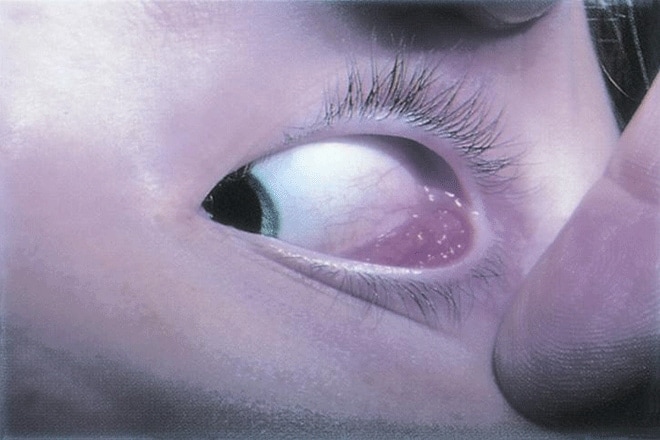 Parinaud syndrome: Symptoms, causes, diagnosis and treatment
