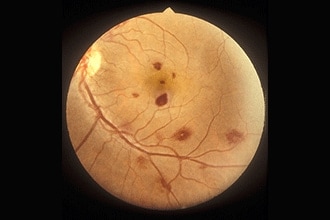 Roth spots: Causes, diagnosis and treatment Roth spots: Causes, diagnosis and treatment
