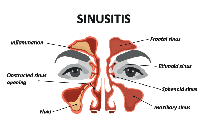 How sinuses affect the eyes, and what you can do about it