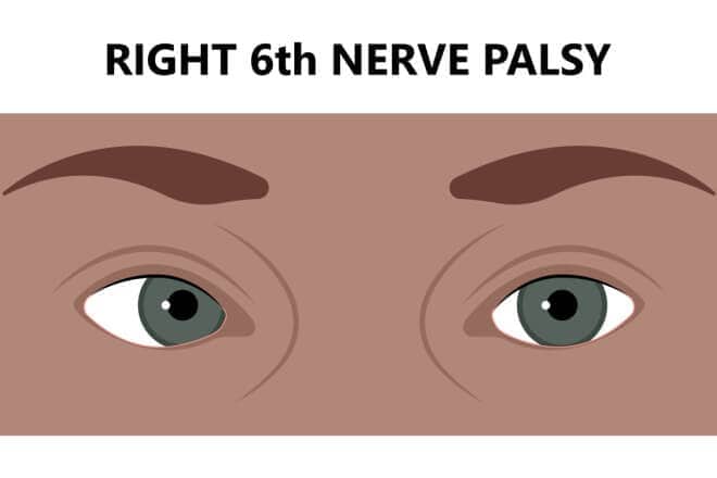 Sixth nerve palsy