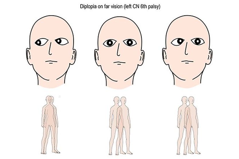 illustration of eyes with sixth nerve palsy which causes double vision