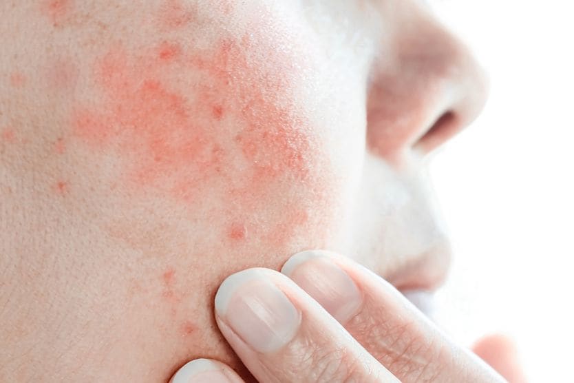 Red rashes appear on woman's face.