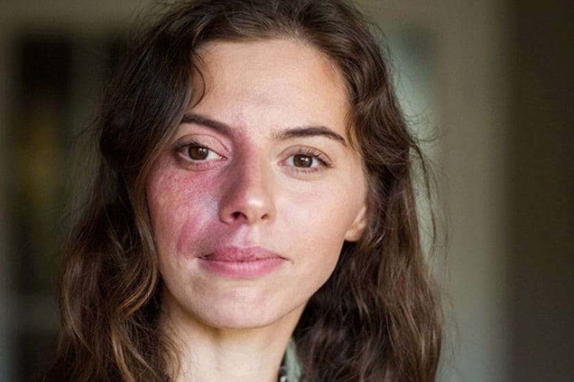 Woman with port-wine stain on side of face.