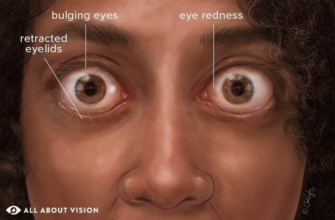 Thyroid eye disease: Symptoms, diagnosis and treatment