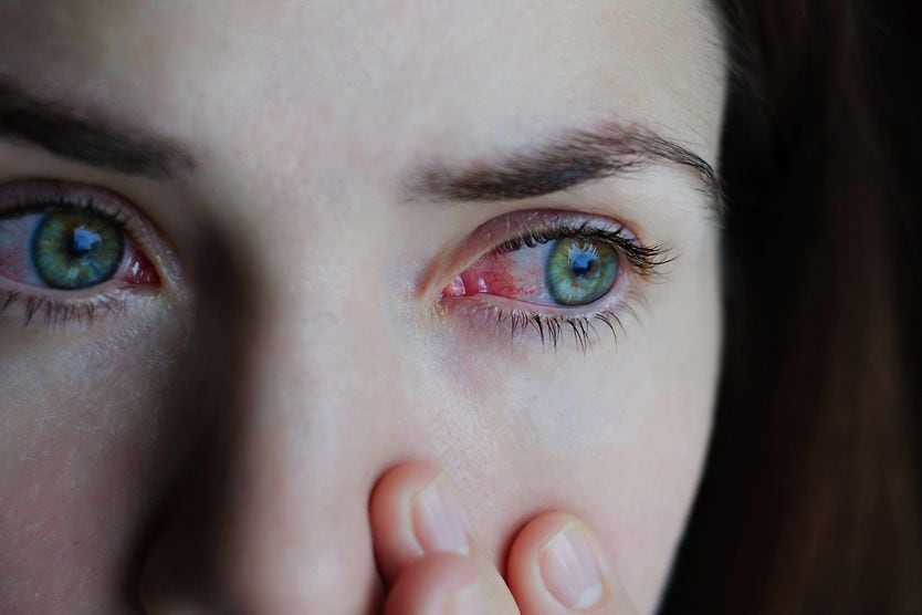Coronavirus (COVID-19) eye symptoms woman with red eyes and coronavirus