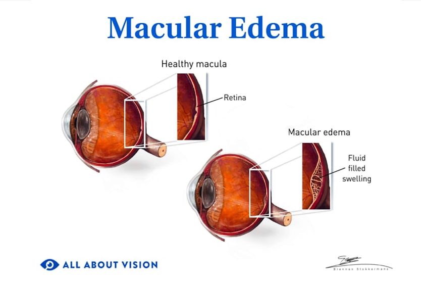 Diabetic macular edema (DME) Healthy macula v macular edema.