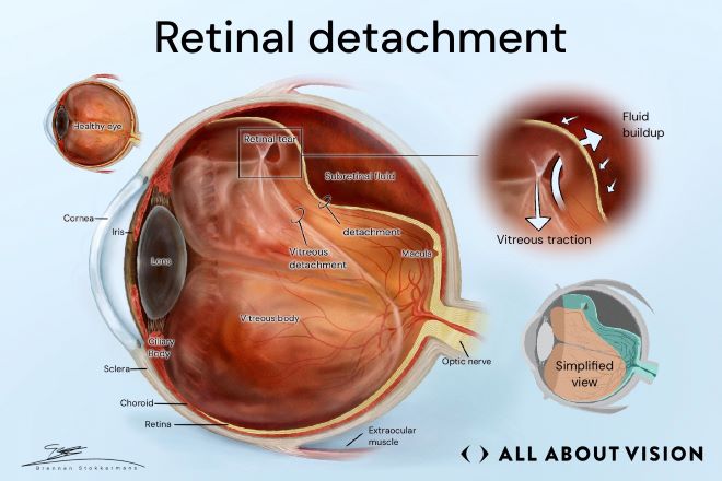Retinal detachment