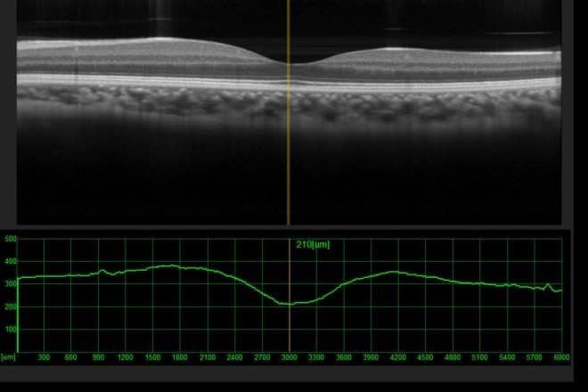 Central serous chorioretinopathy (central serous retinopathy) Central serous chorioretinopathy (central serous retinopathy)