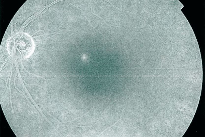 Central serous chorioretinopathy (central serous retinopathy) Fluorangiography showing left eye with central serous chorioretinopathy