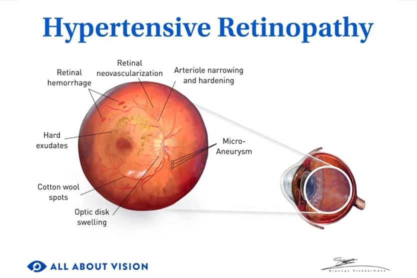 Hypertensive retinopathy (HTN retinopathy) hypertensive retinopathy medical illustration.