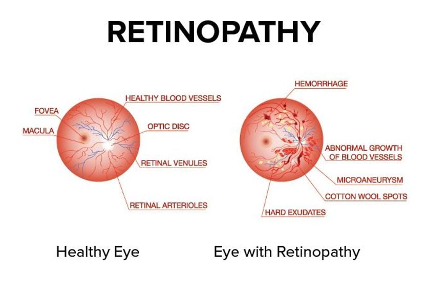 Retinopathy diagram illustrating the difference between and eye with retinopathy vs. a healthy eye