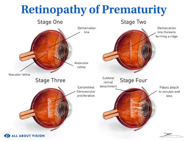 Retinopathy of prematurity (ROP)