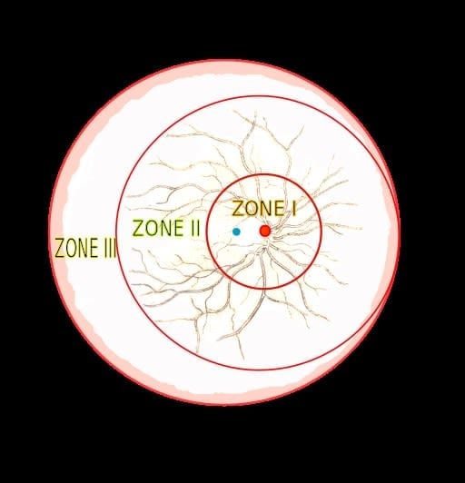 Retinopathy of prematurity (ROP) Retinopathy of prematurity (ROP)