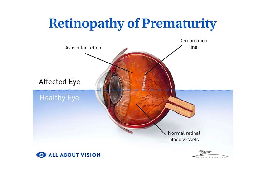 Retinopathy of prematurity (ROP) Normal eye v eye with retinopathy of prematurity.