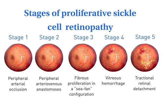 Retinopathy of prematurity (ROP)