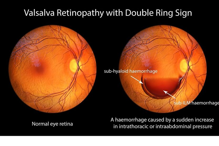 Valsalva retinopathy Close up of man with broken blood vessel in eye