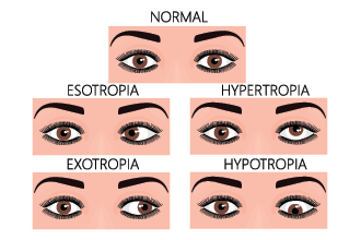Hypertropia: Causes, symptoms and treatment