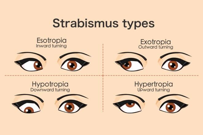 child with strabismus