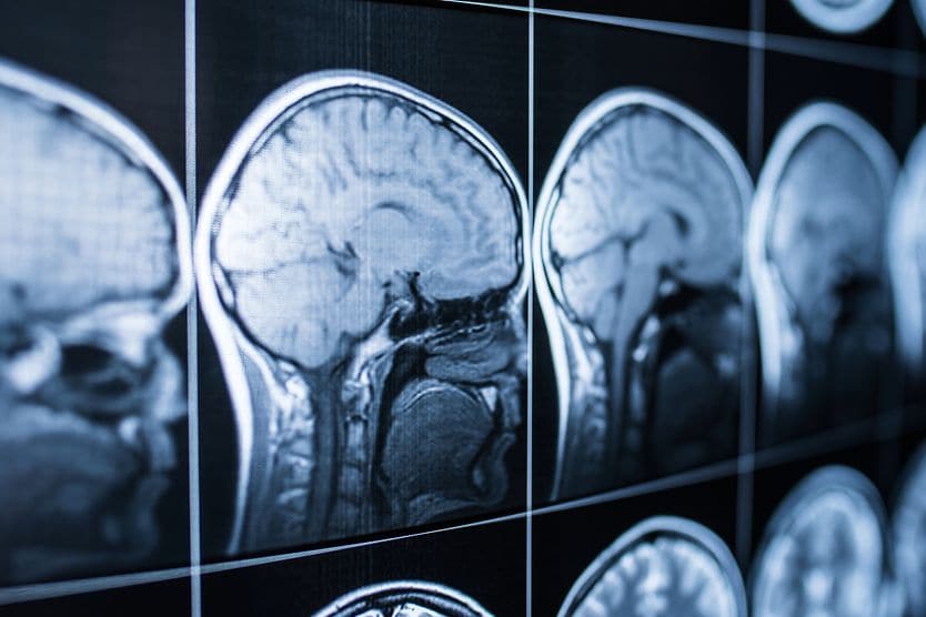 X-Ray of a concussion