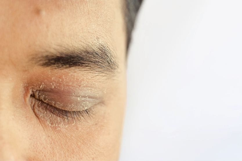Dry eyelids: Symptoms, causes and treatments closeup of eyelids with dry skin