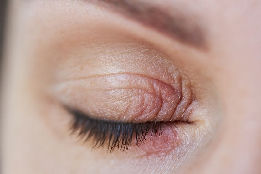 Eyelid inflammation: Causes and treatment close up of a swollen eyelid