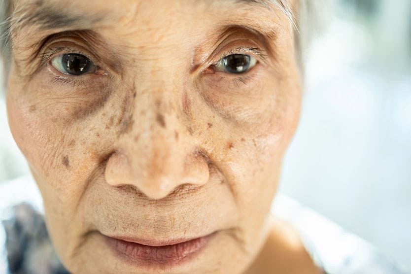 Sunken eyes (enophthalmos) elderly woman with sunken eyes