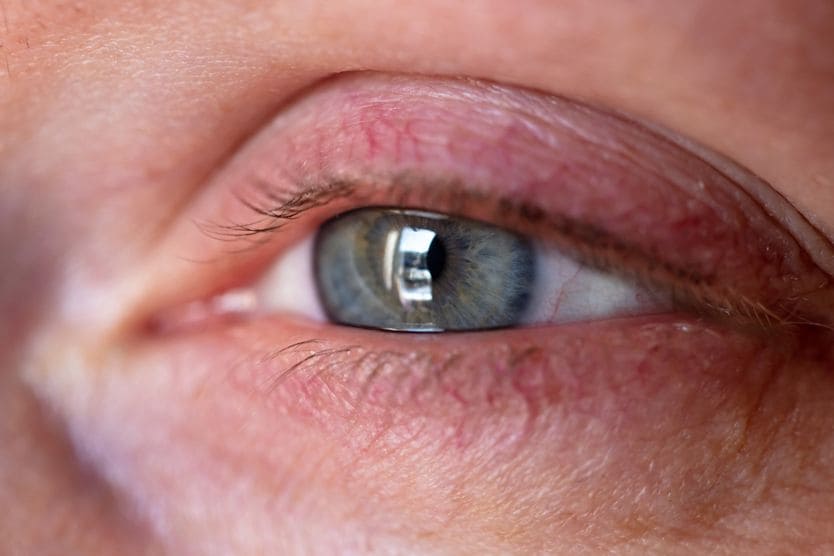 How to stop watery eyes or teary eyes Teary eye looking out the window.