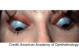 Blue sclera: Definition, causes and associated conditions