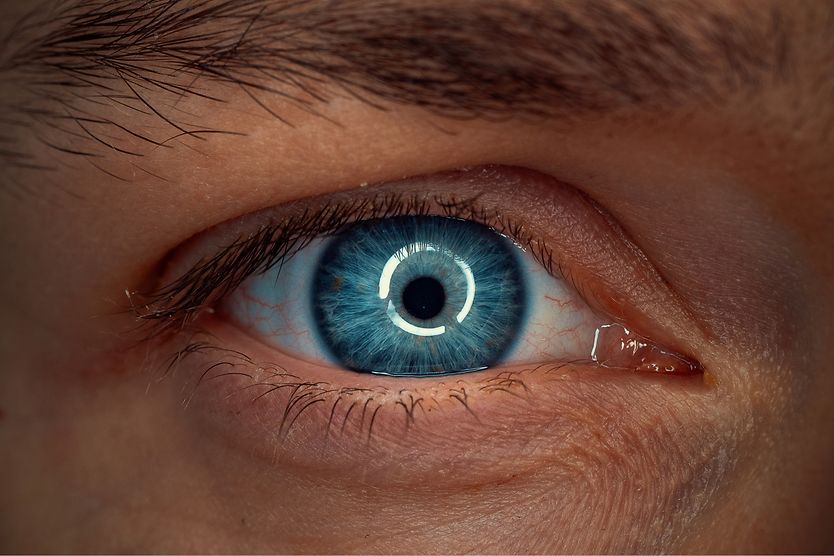 eyeball with a blue sclera