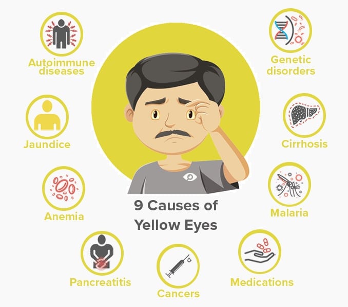 Yellow eyes: Causes and treatment