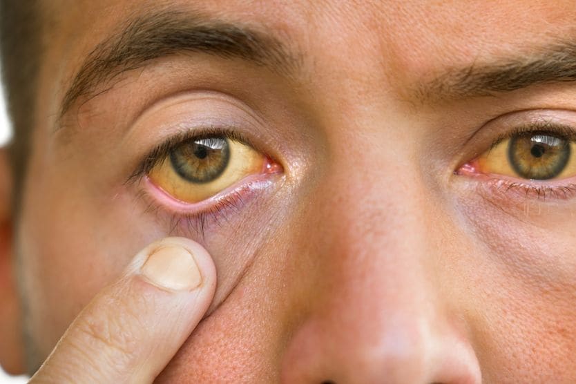 Yellow eyes: Causes and treatment man with yellow eyes