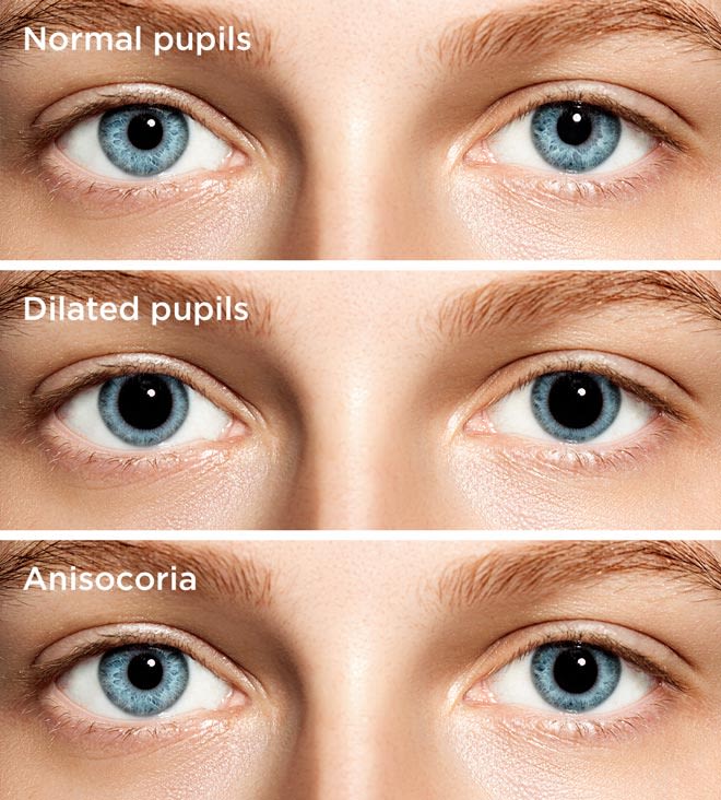 What causes dilated pupils (dilated eyes)?