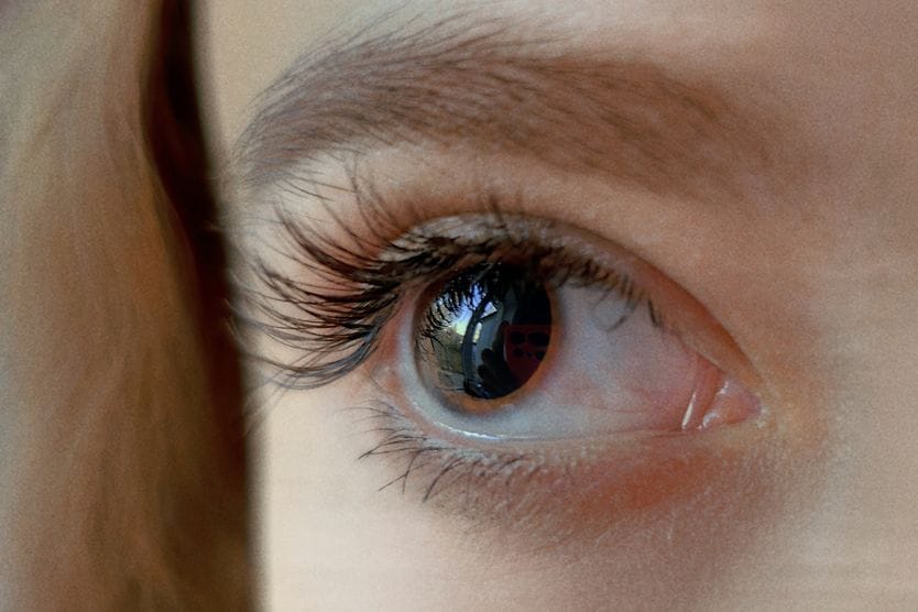 What causes dilated pupils (dilated eyes)? Woman with dilated pupils.