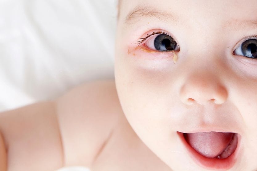 Goopy eyes: Causes and treatment infant with goopy eye