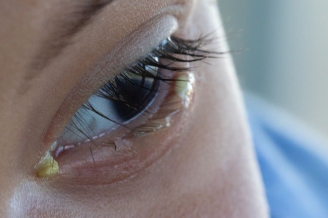 young girl with eye discharge