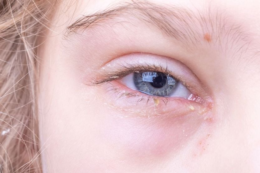 young girl with eye discharge