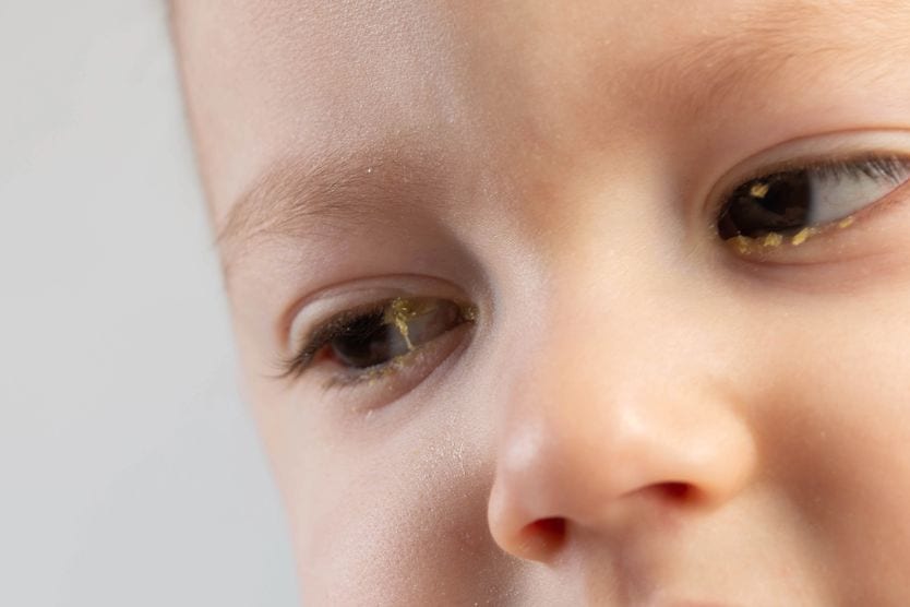 Sticky Eyes: Causes and Treatment toddler with sticky eye discharge