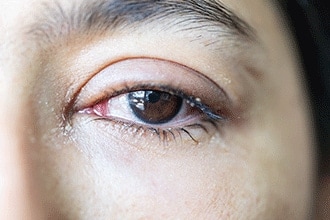 Eye discharge: White vs. yellow vs. green