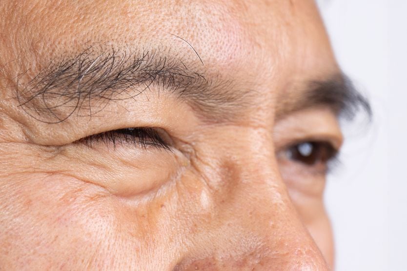 Blepharospasm: Symptoms, causes and treatment man with a blinking eye