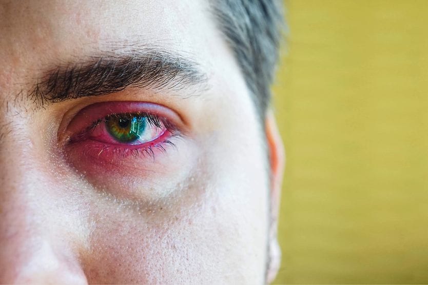 Eye inflammation man with eye inflammation