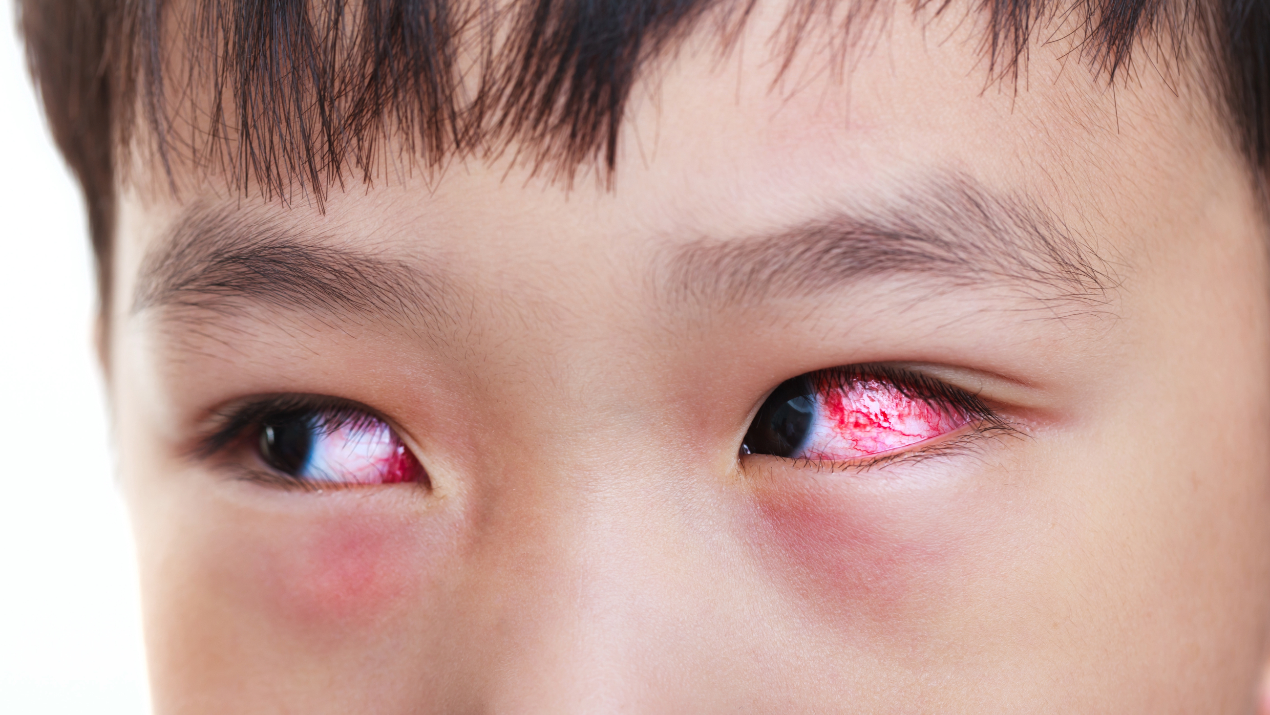 Young boy with red, inflamed eye