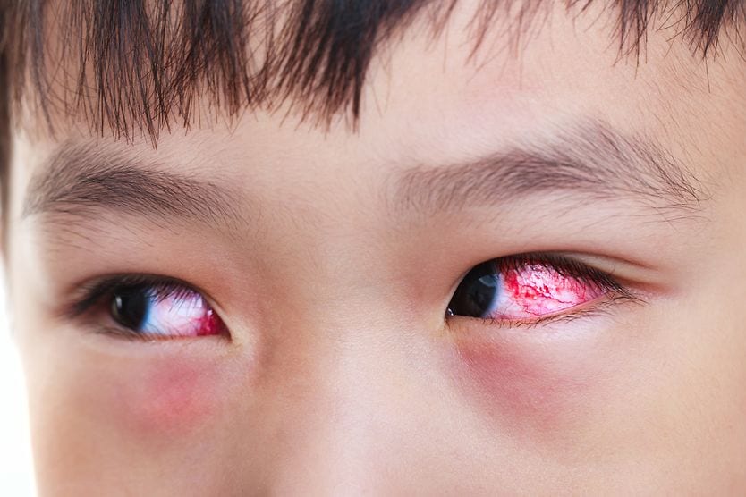 Treating your infant’s or child’s red or bloodshot eyes Young boy with red, inflamed eye
