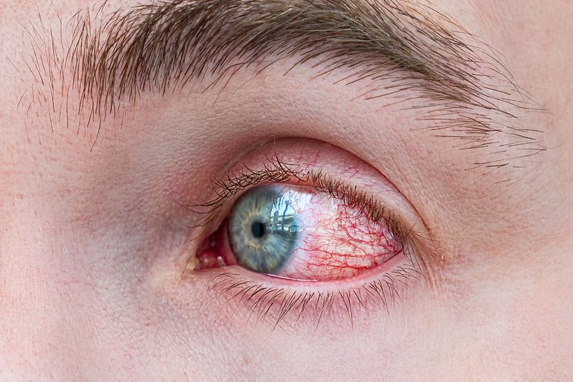 Eye redness (bloodshot eyes) illustration of red eyes (inflamed and irritated sclera)