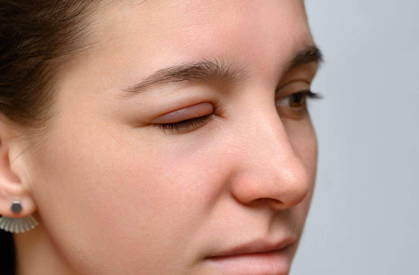 Swollen eyelid causes and how to treat a swollen eyelid